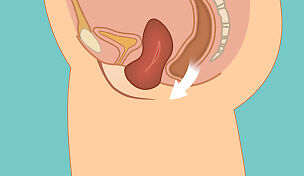wow-l2-bladder-and-pelvic-floor-problems-id10097-02.jpg